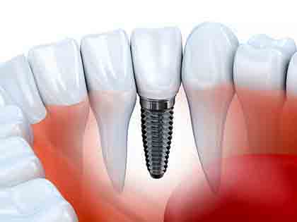 Implantes dentales - Perito Implantes dentales