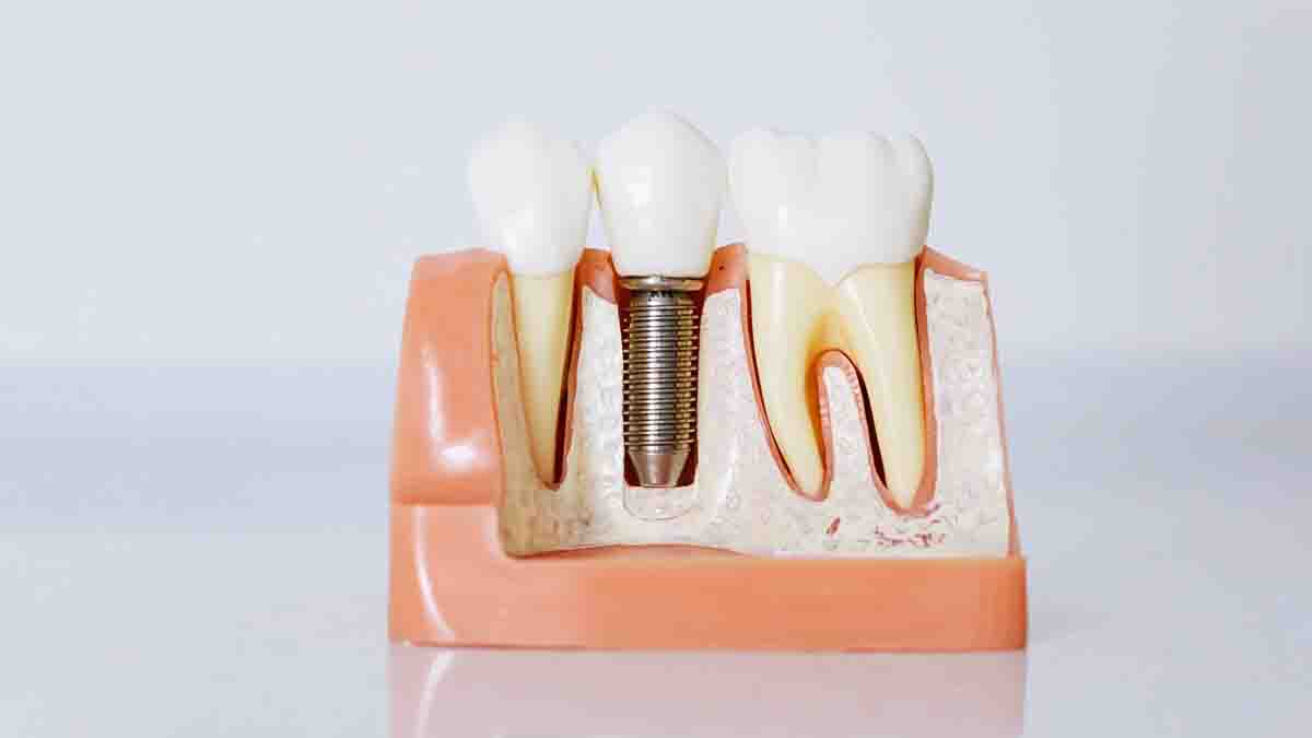 Perito en Implantes Dentales: rechazo, alergias, roturas